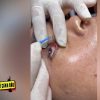 Nguy cơ hỏng thị lực từ dịch vụ ‘bắt sâu mắt’