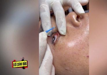 Nguy cơ hỏng thị lực từ dịch vụ ‘bắt sâu mắt’