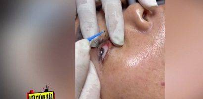 Nguy cơ hỏng thị lực từ dịch vụ ‘bắt sâu mắt’