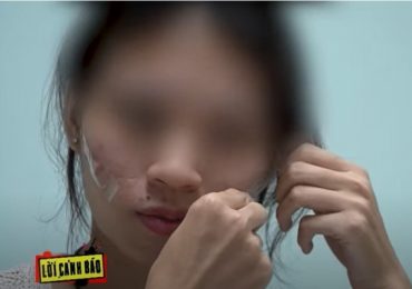 Lời cảnh báo: Hiểm họa từ trào lưu dán keo lên mặt giảm nếp nhăn