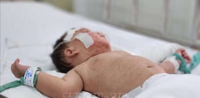 Thời gian ủ bệnh của người mắc sởi